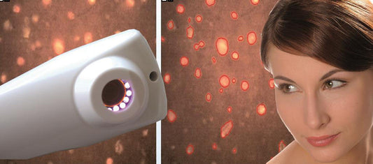 Visiopor PP 34 N - Showing Acne Bacteria Activity by Skin Fluorescence